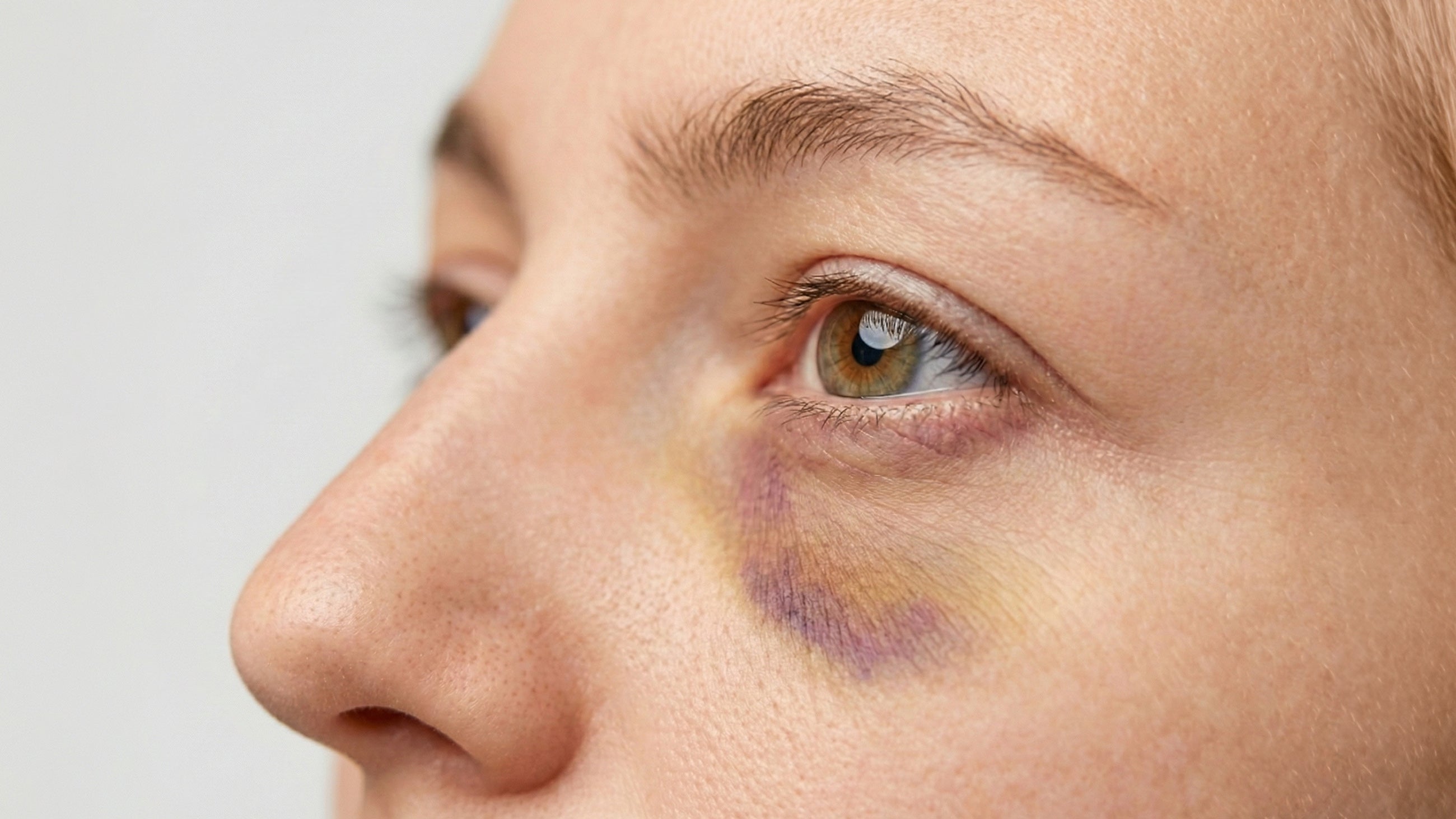 The Best Bruise Recovery Cream After Injectables: What to use and how to use it