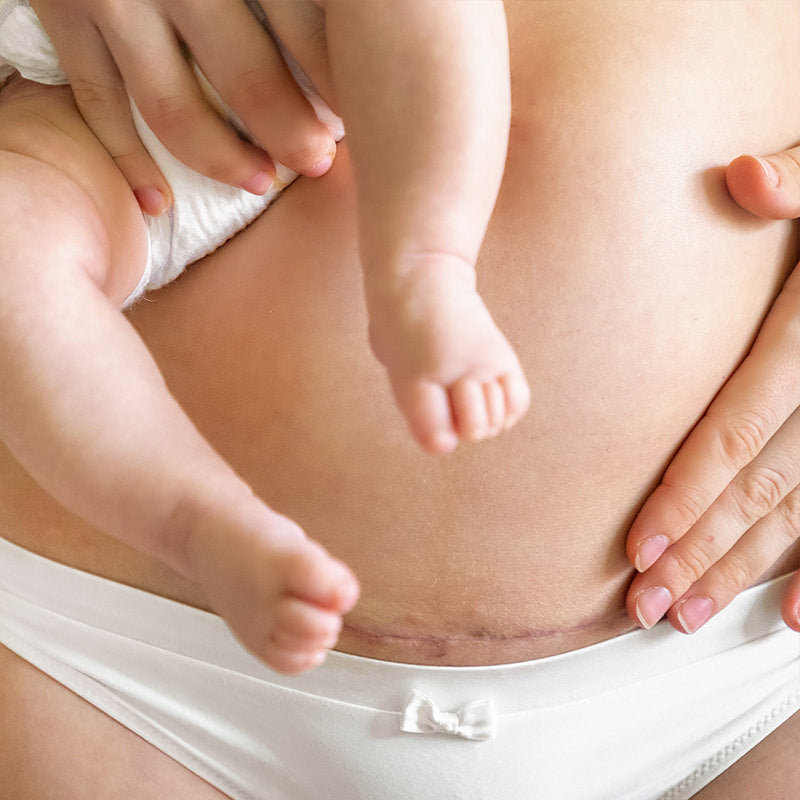 Scar and Stretch Mark Package Pricing Cincinnati Mason OH Fix Studios