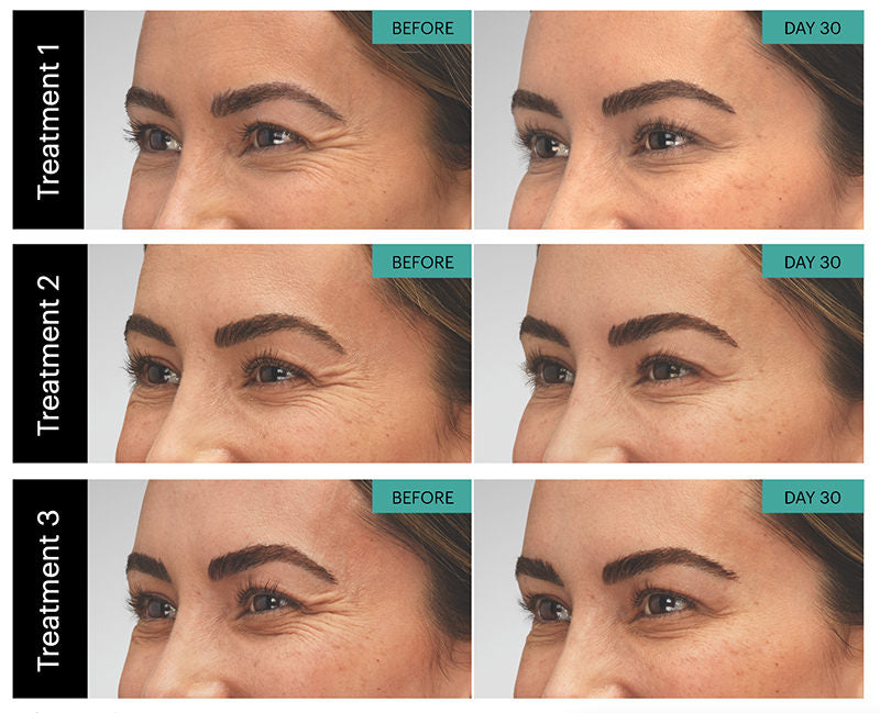 Before and after comparison of Botox facial treatments on a person's face.