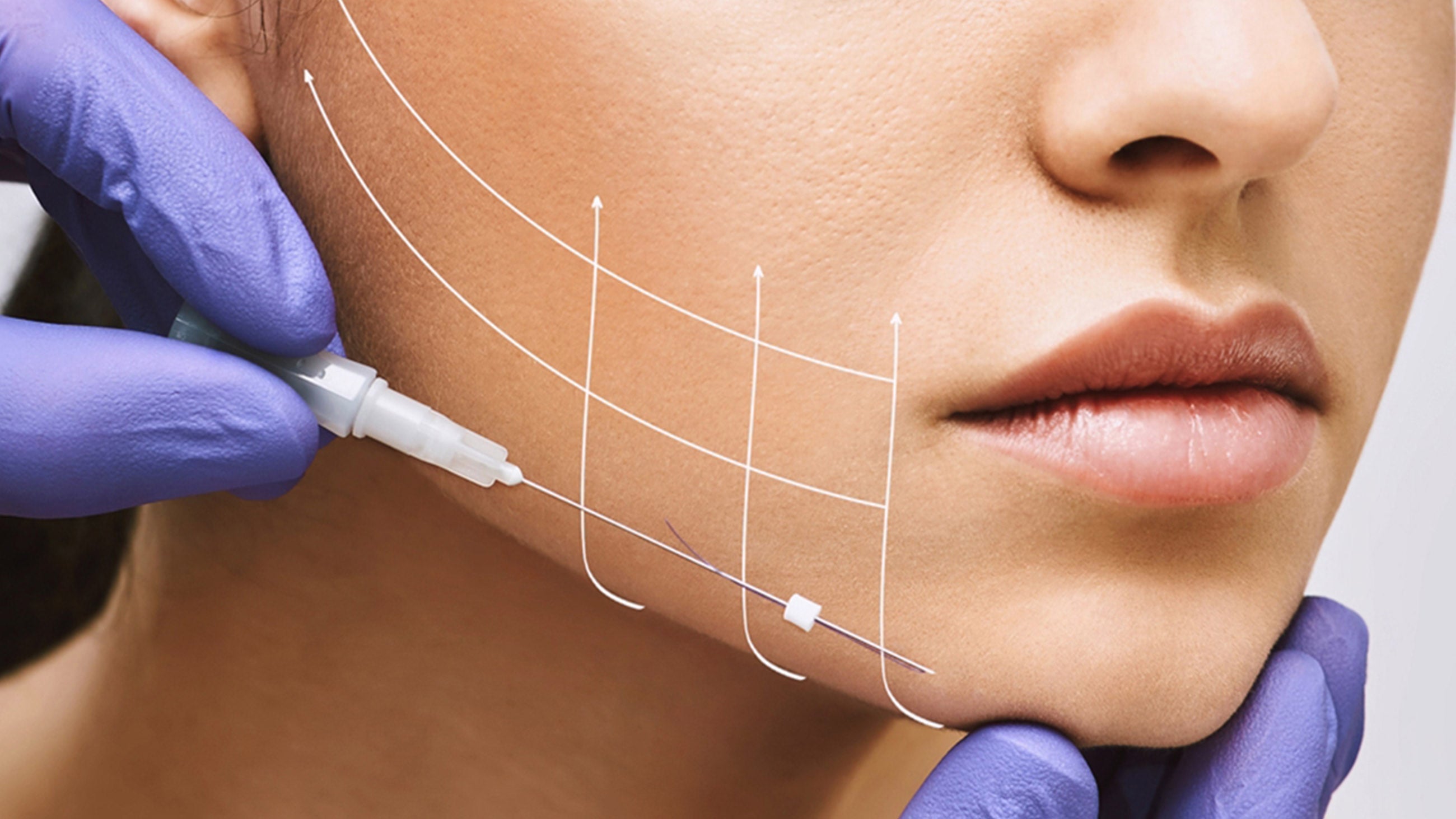 Non-Surgical PDO Thread Jawline Thread Lift