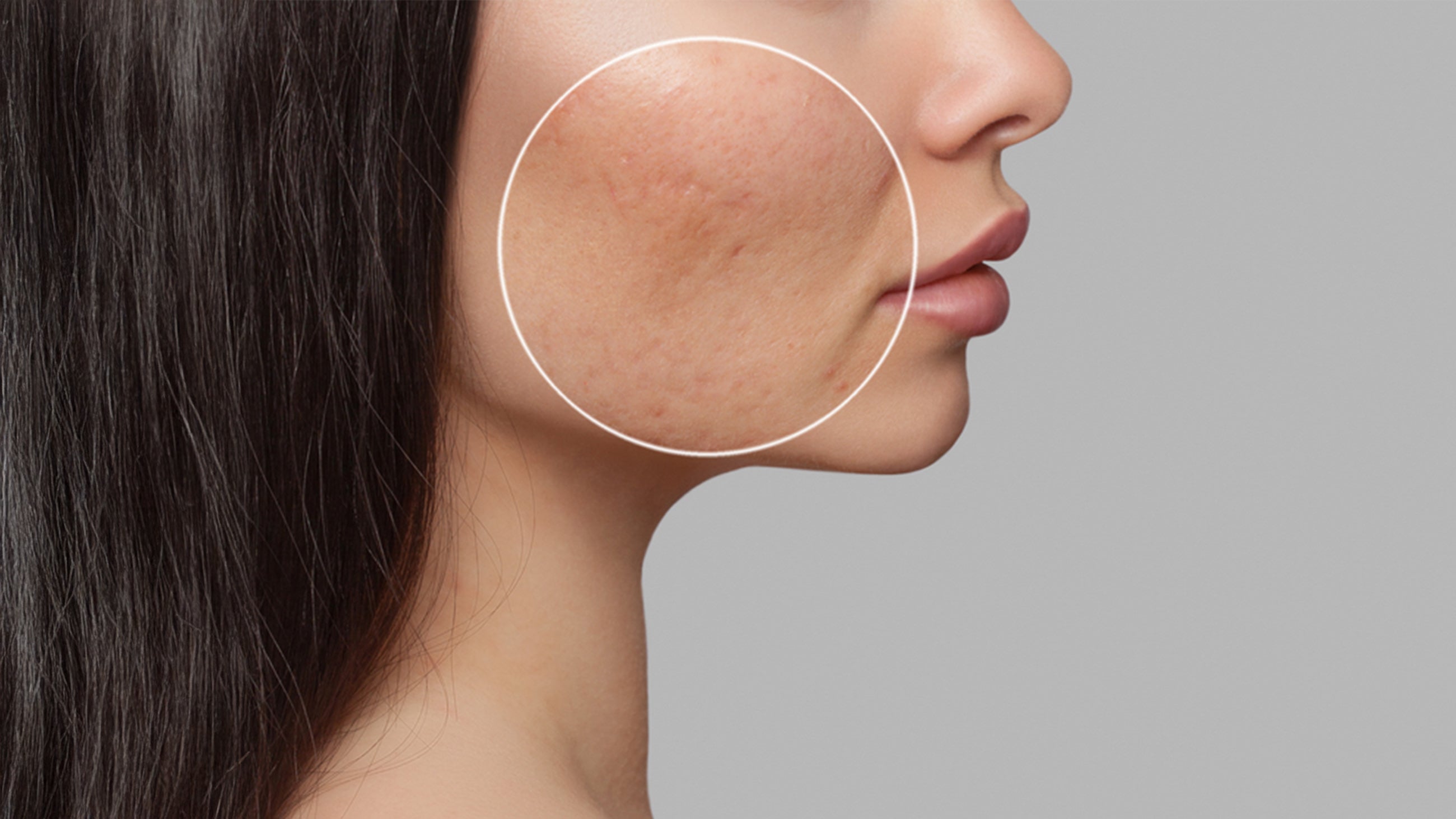 PRP Microneedling & PDO Threads – The Best Acne Scar Treatment: