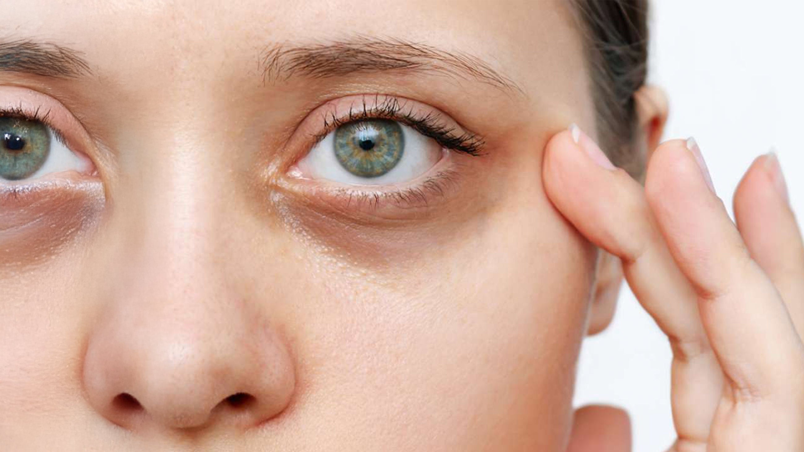 PRF Undereye Filler in Cincinnati for Dark Circles & Wrinkles
