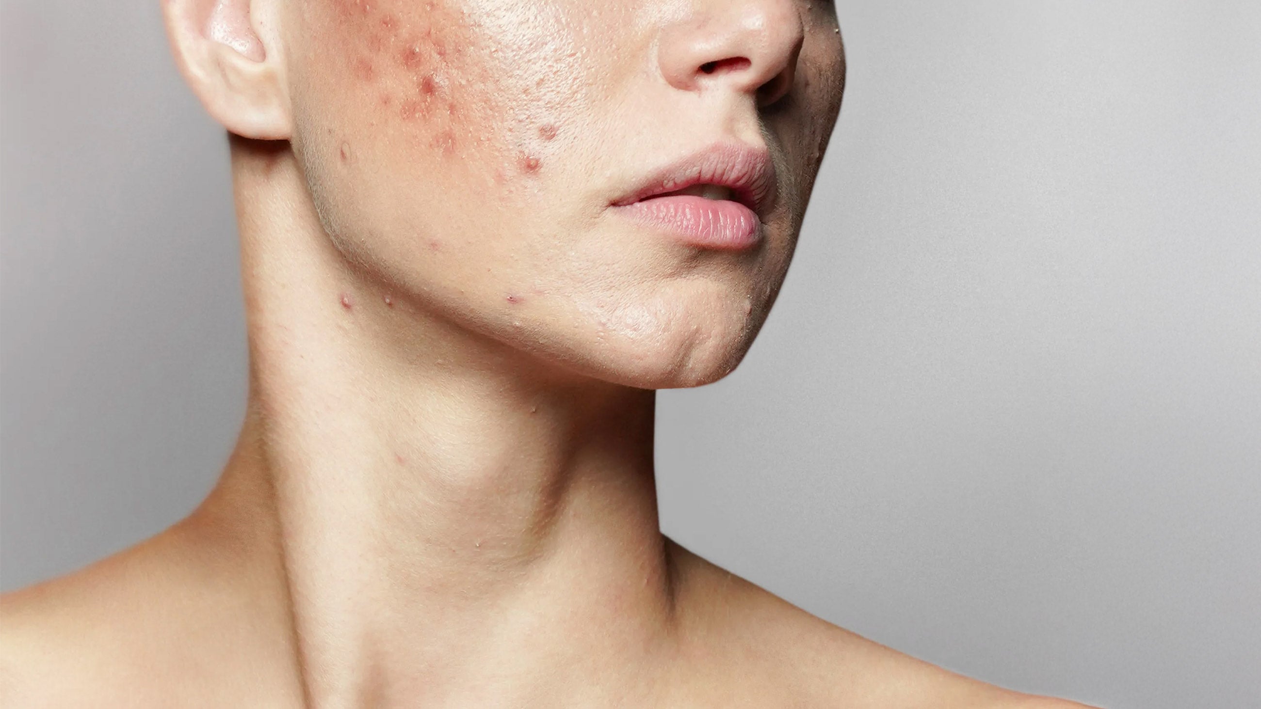 Acne Scars Cincinnati: Effective treatments, costs, and real results