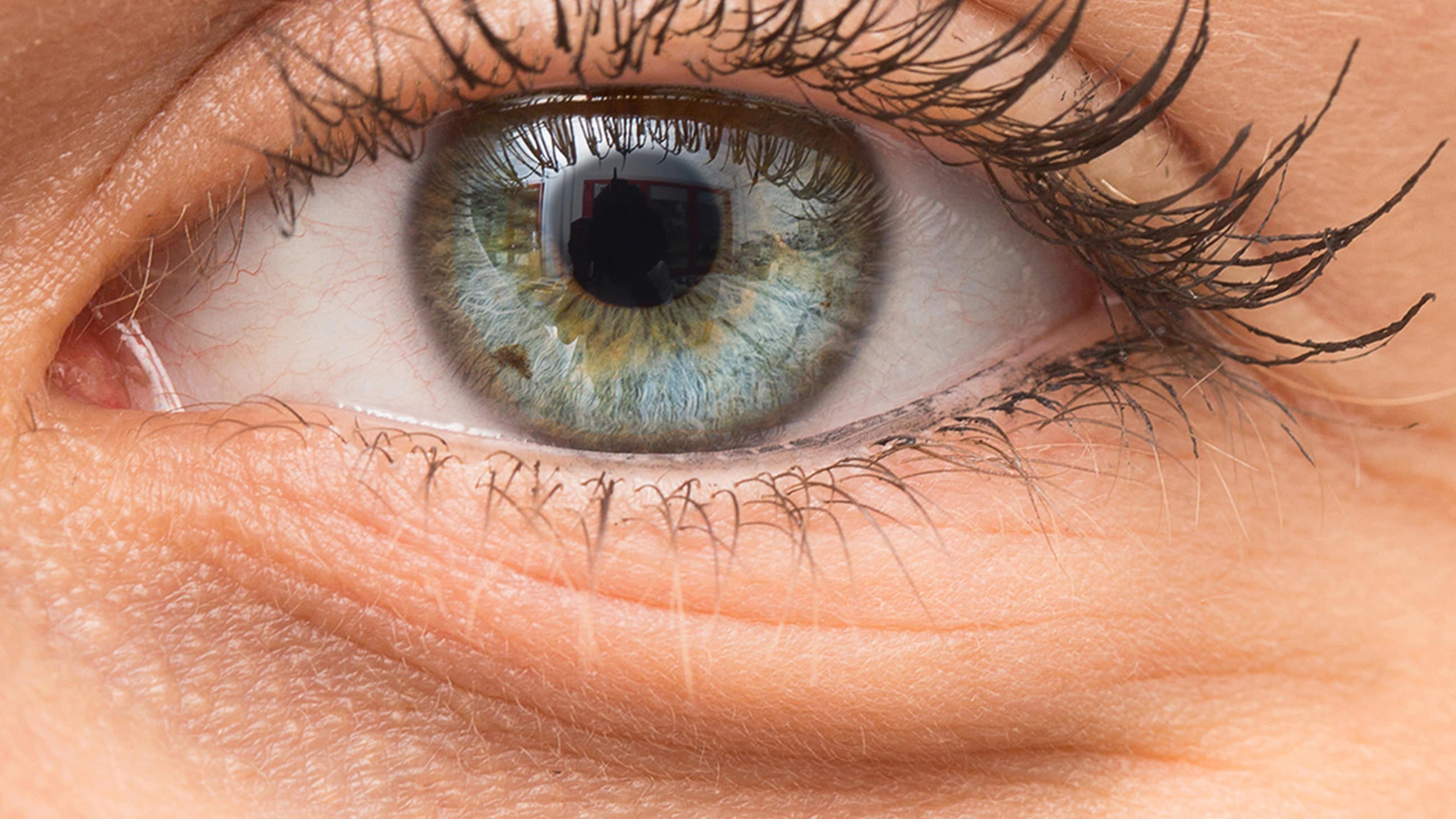 The Solution for Dark Circles: Under Eye Filler