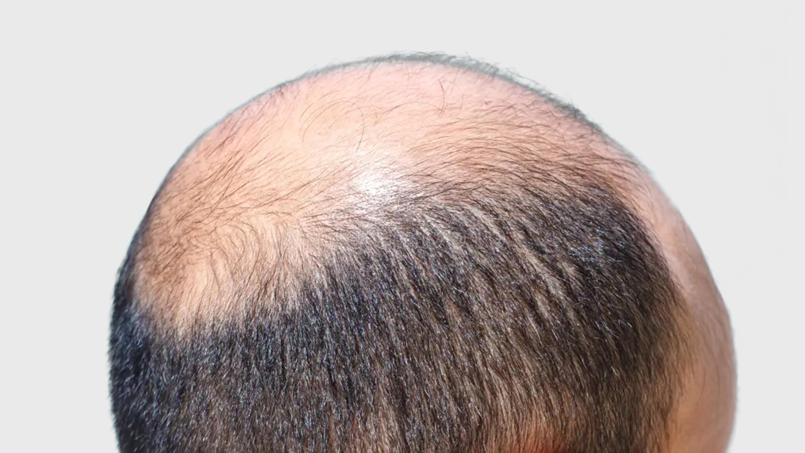 7 Reasons PRP + Morpheus8 Is Changing Hair Restoration Cincinnati