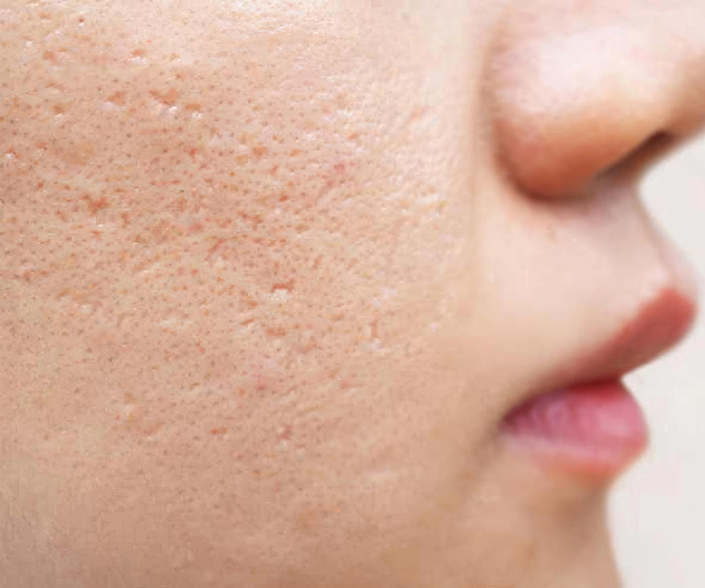 Acne Scar Treatment services fix studios cincinnati mason OH
