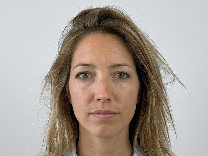 Botox Cincinnati Mason OH Before and After Fix Studios