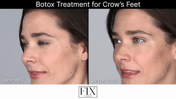 Botox treatments and services fix studios medspa cincinnati mason OH