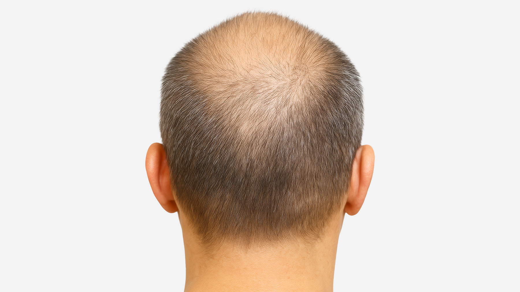 Hair Restoration Treatment services before and after fix studios cincinnati mason OH
