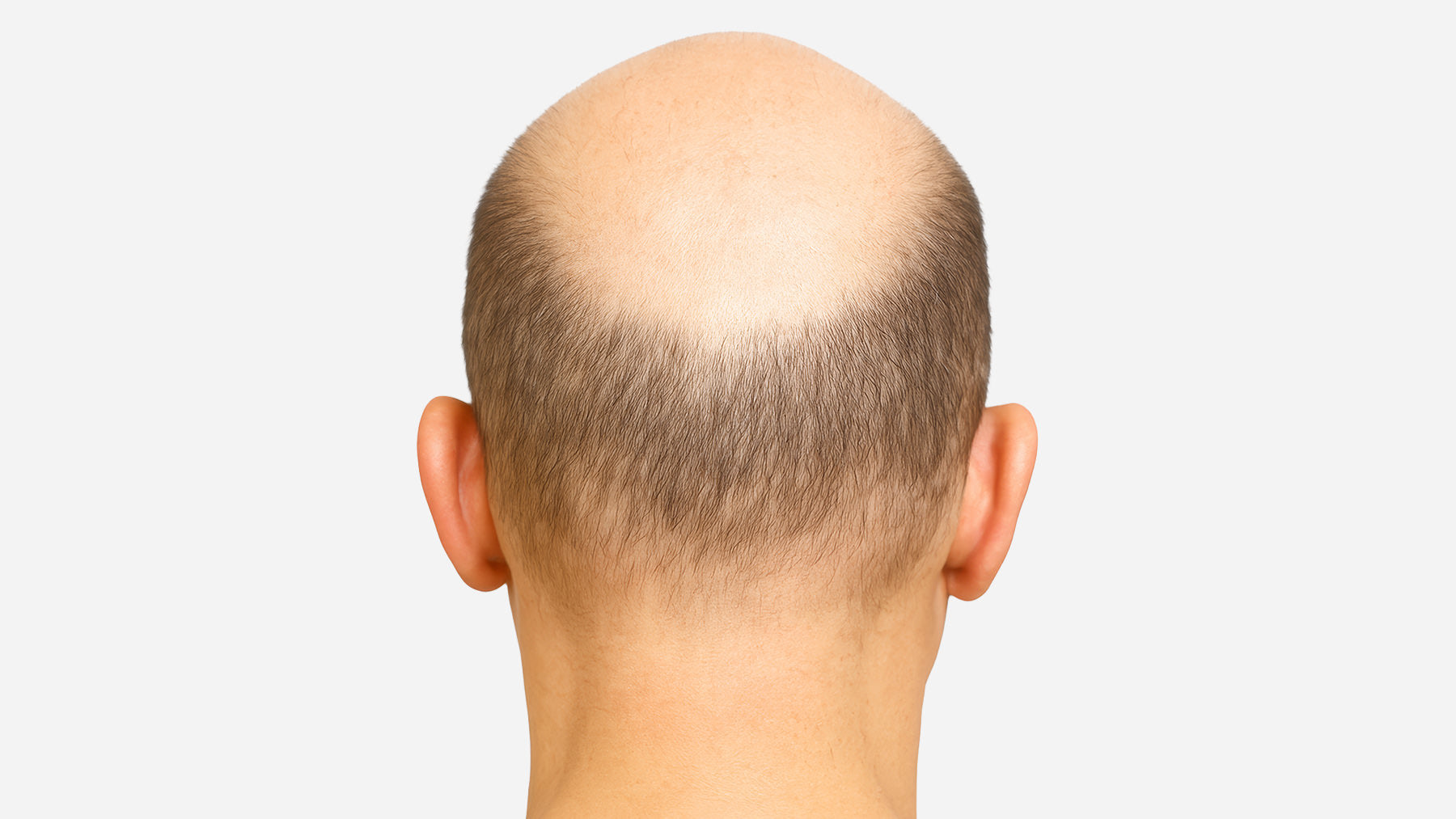 Hair Restoration Treatment services before and after fix studios cincinnati mason OH
