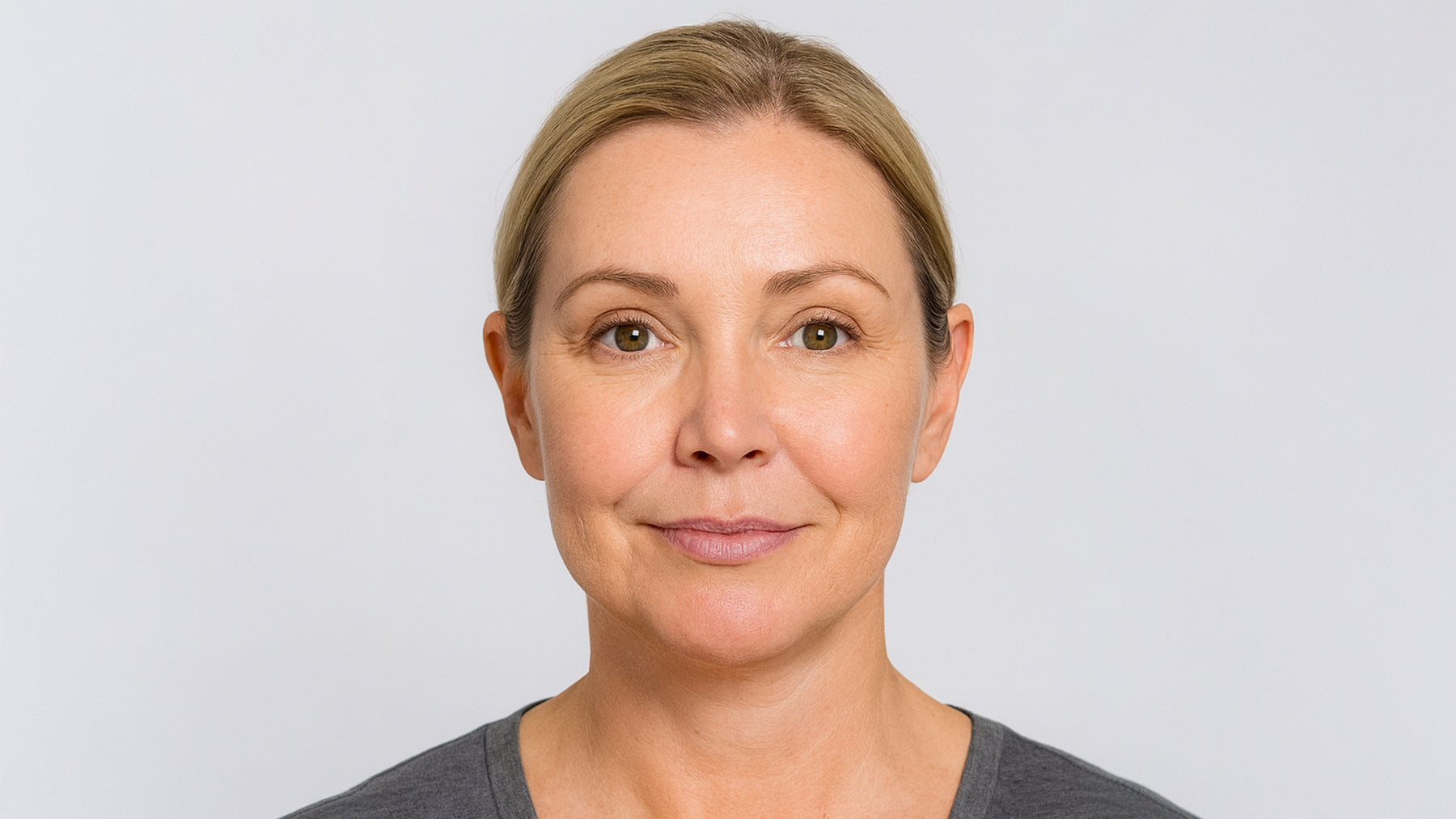 Forma RF Skin Tightening treatment at Fix Studios Cincinnati Mason OH Before and After