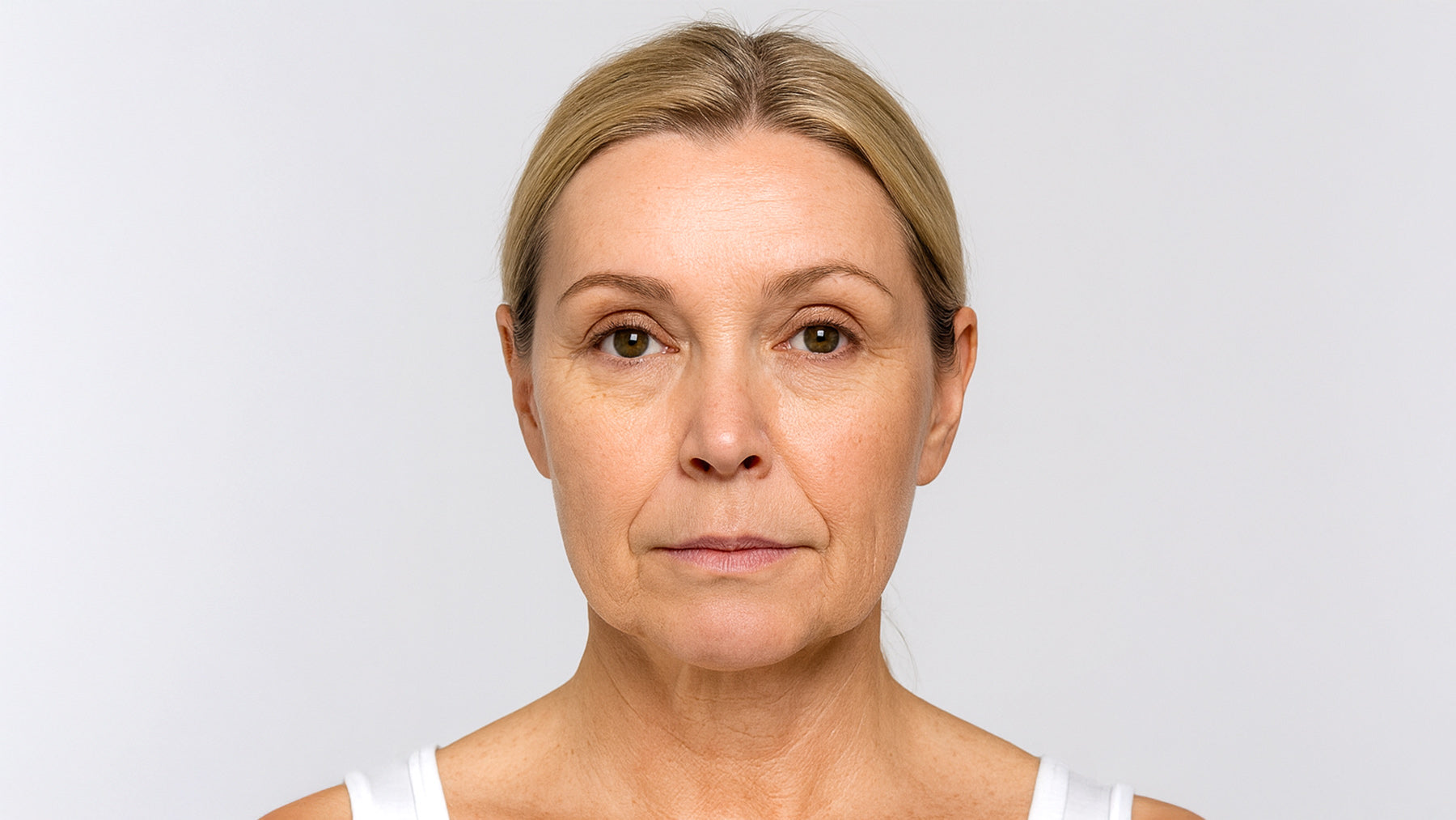Forma RF Skin Tightening treatment at Fix Studios Cincinnati Mason OH Before and After