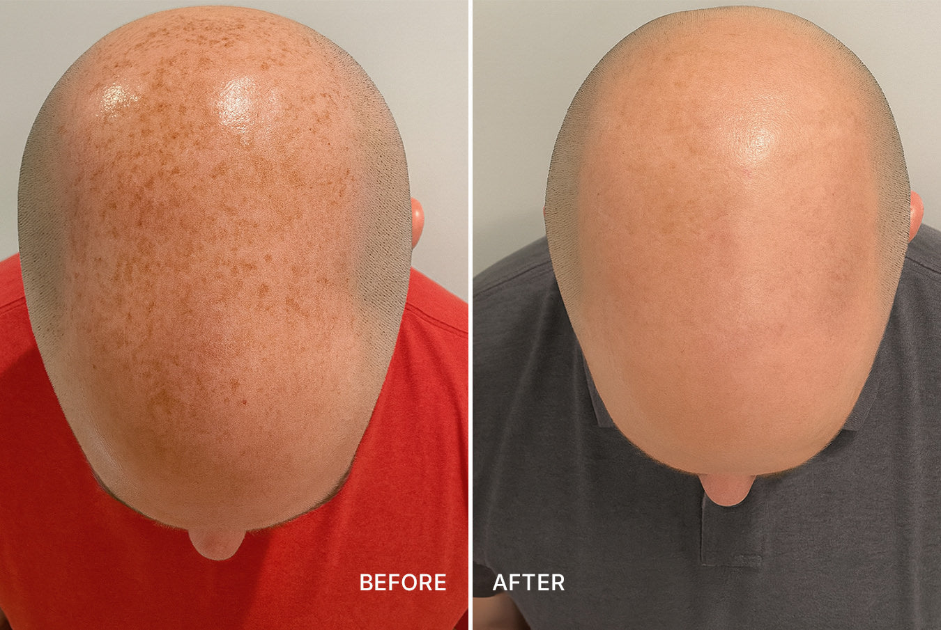 Lumecca IPL Photofacial treatment cincinnati mason OH before after at Fix Studios