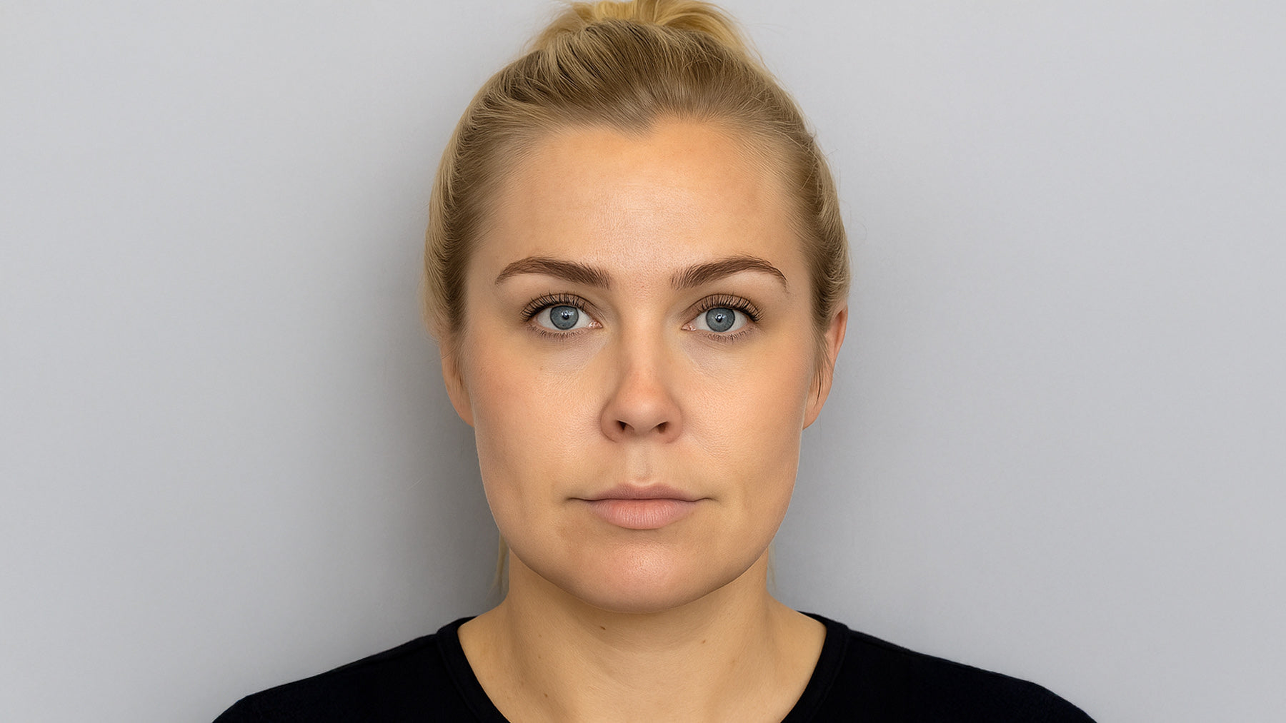 Lumecca IPL Photofacial treatment cincinnati mason OH before after at Fix Studios