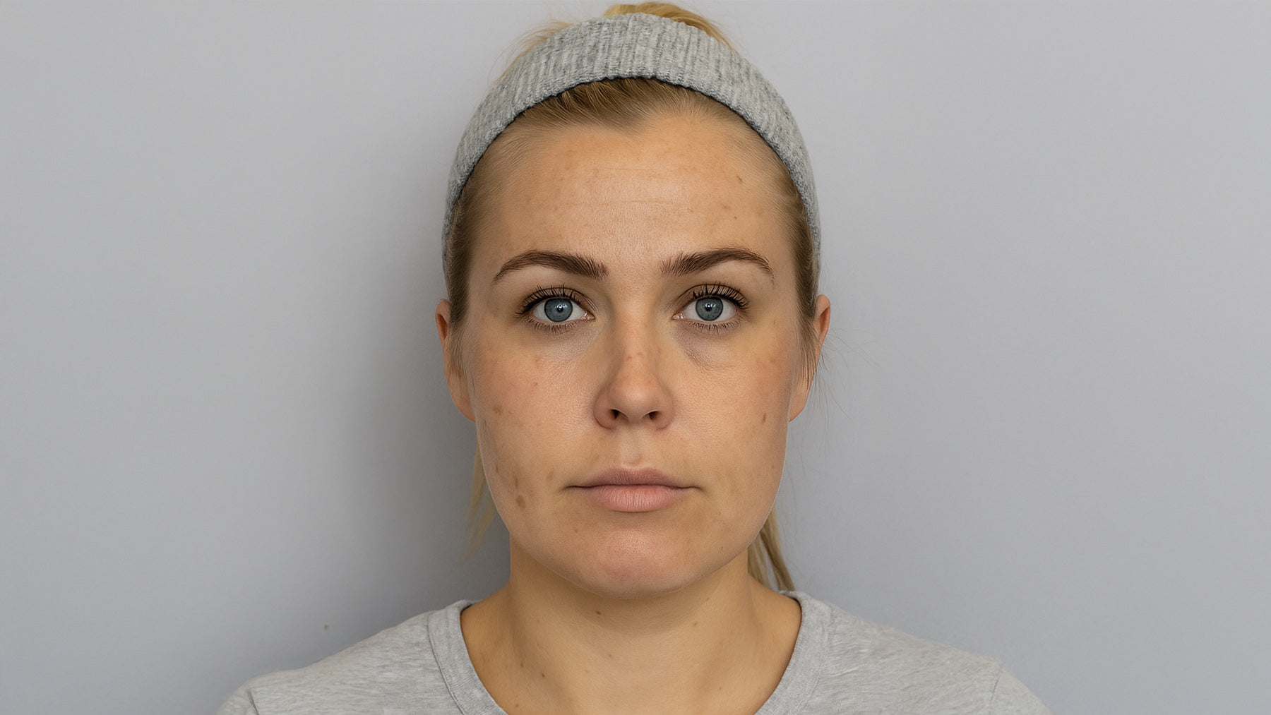 Lumecca IPL Photofacial treatment cincinnati mason OH before after at Fix Studios