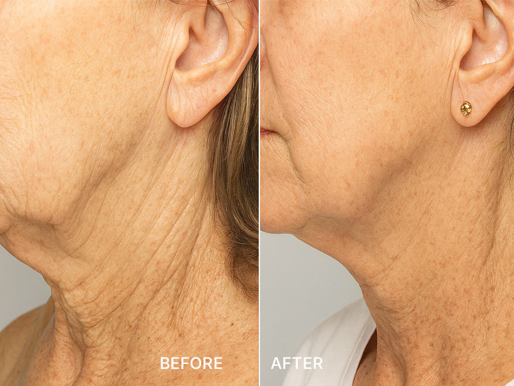 Morpheus8 RF Microneedling Skin Tightening Cincinnati Mason OH before and after Fix Studios