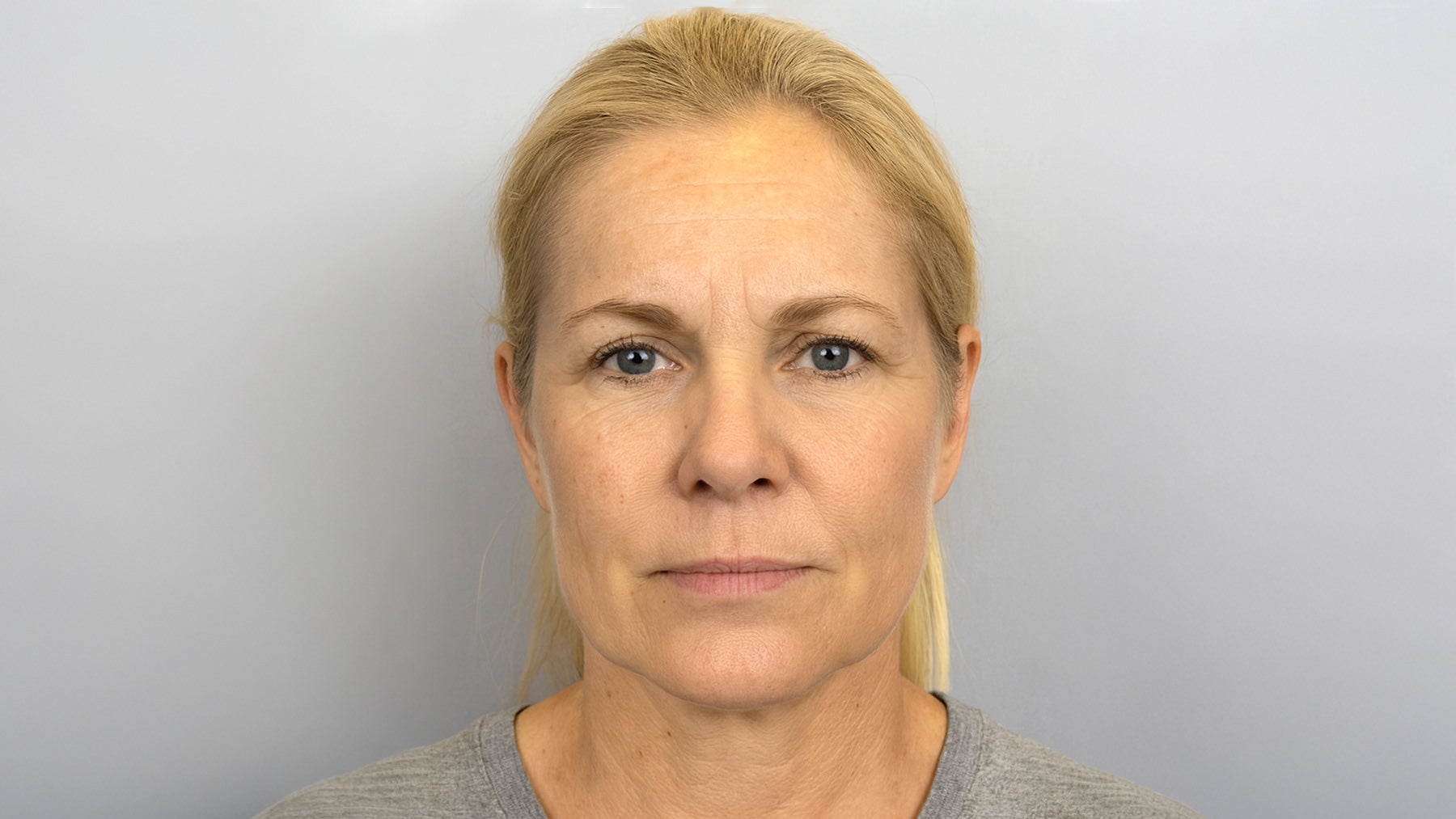 Morpheus8 RF microneedling skin tightening Cincinnati Mason before after at Fix Studios