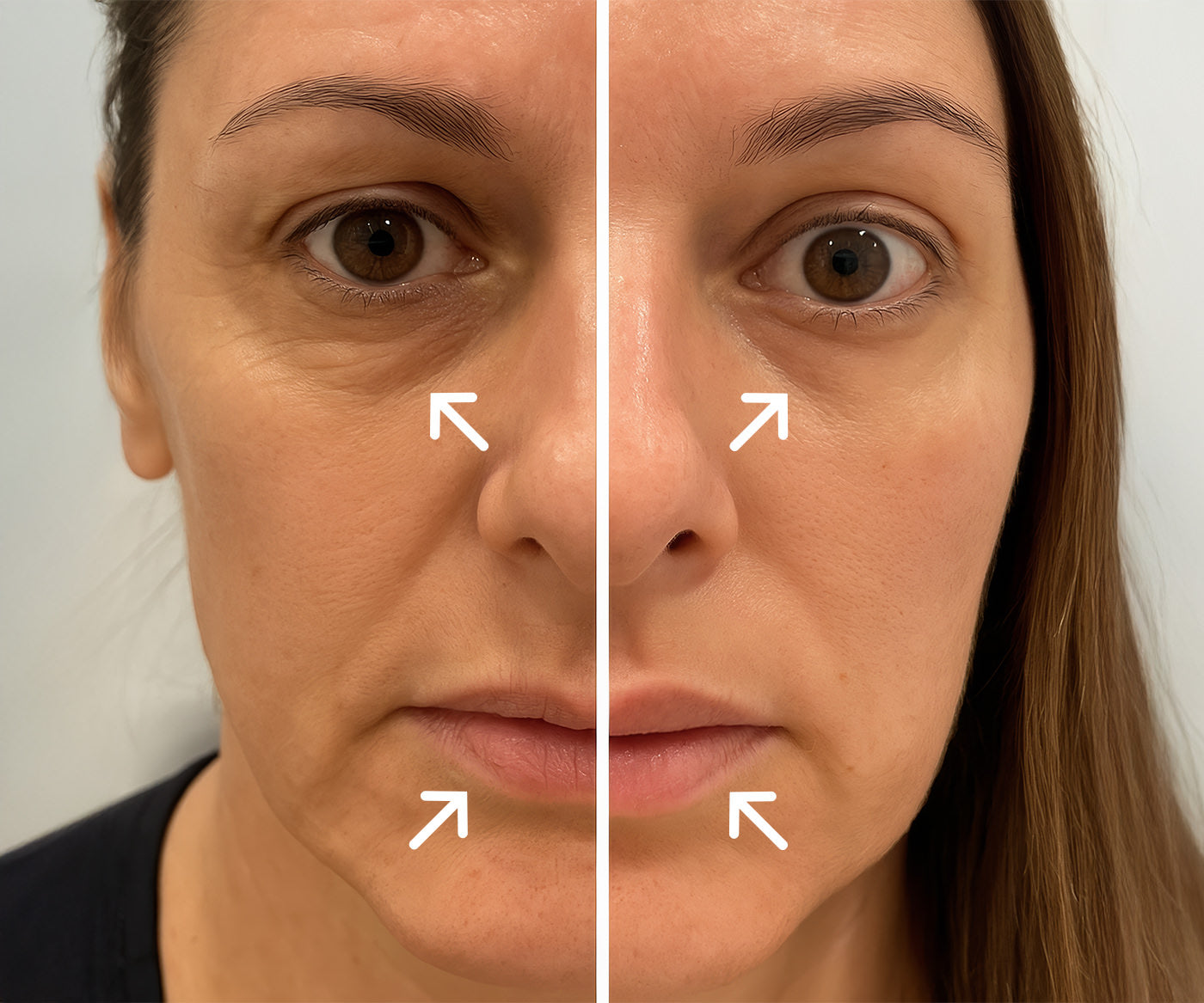 PRP/PRF anti-aging treatments and services before and after fix studios medspa cincinnati mason OH