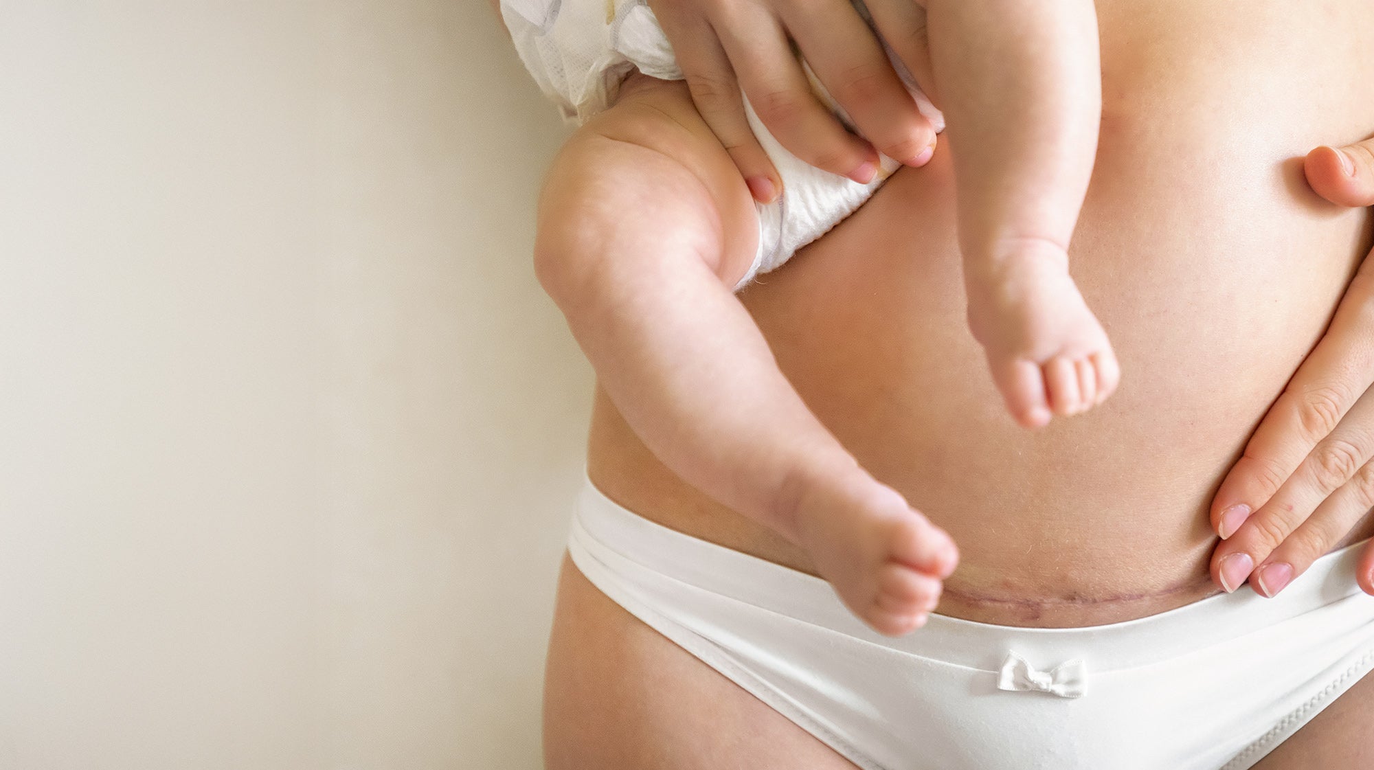 Scar and Stretch Mark repair package pricing Fix Studios Cincinnati Mason OH