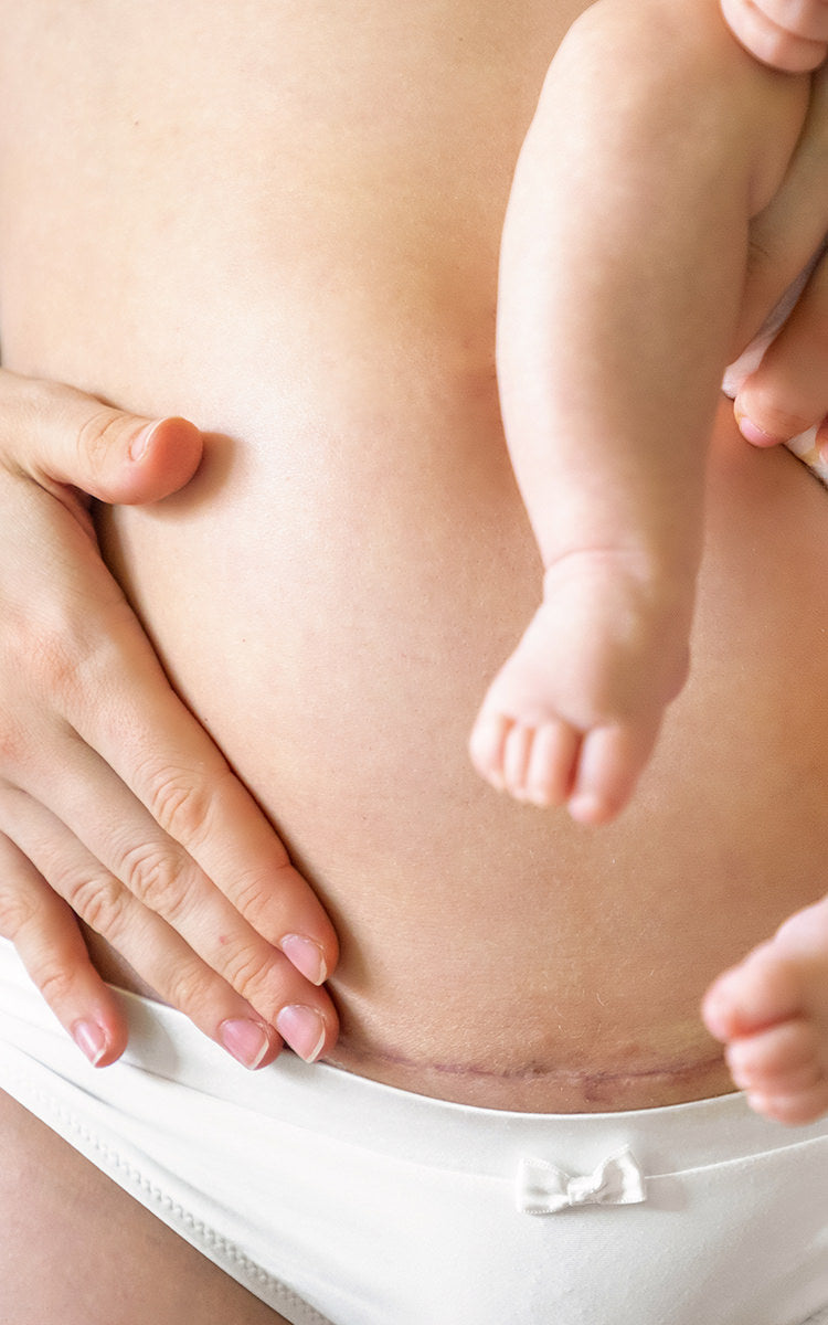 Scar and Stretch Mark repair package pricing Fix Studios Cincinnati Mason OH