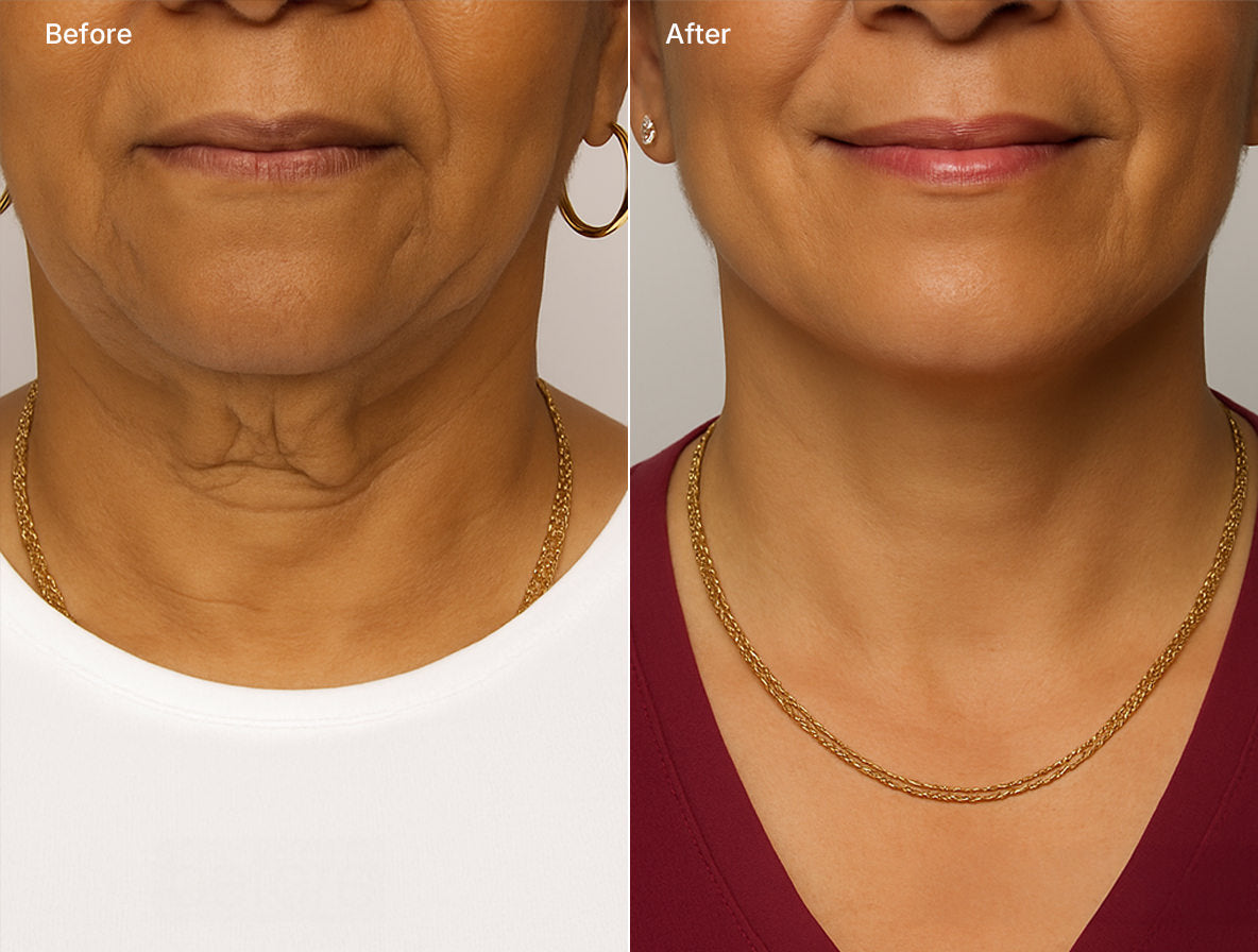 Forma RF Skin Tightening before and after Fix Studios Cincinnati Mason OH