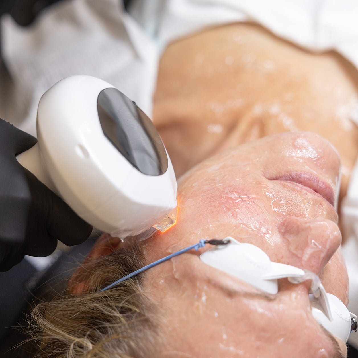 Lumecca IPL Photofacial Cincinnati Mason at Fix Studios