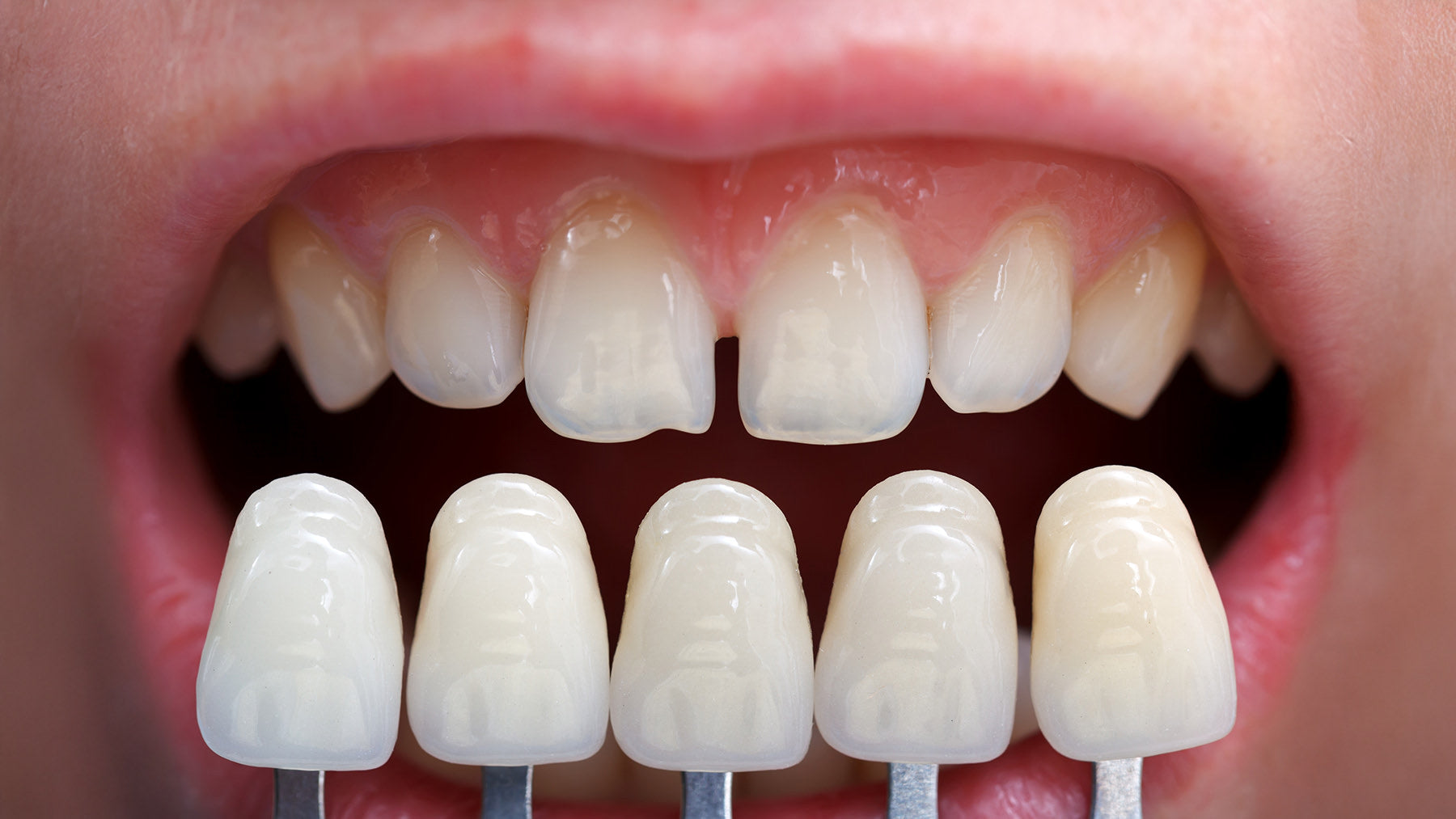 Professional teeth whitening before and after at Fix Studios Cincinnati Mason OH