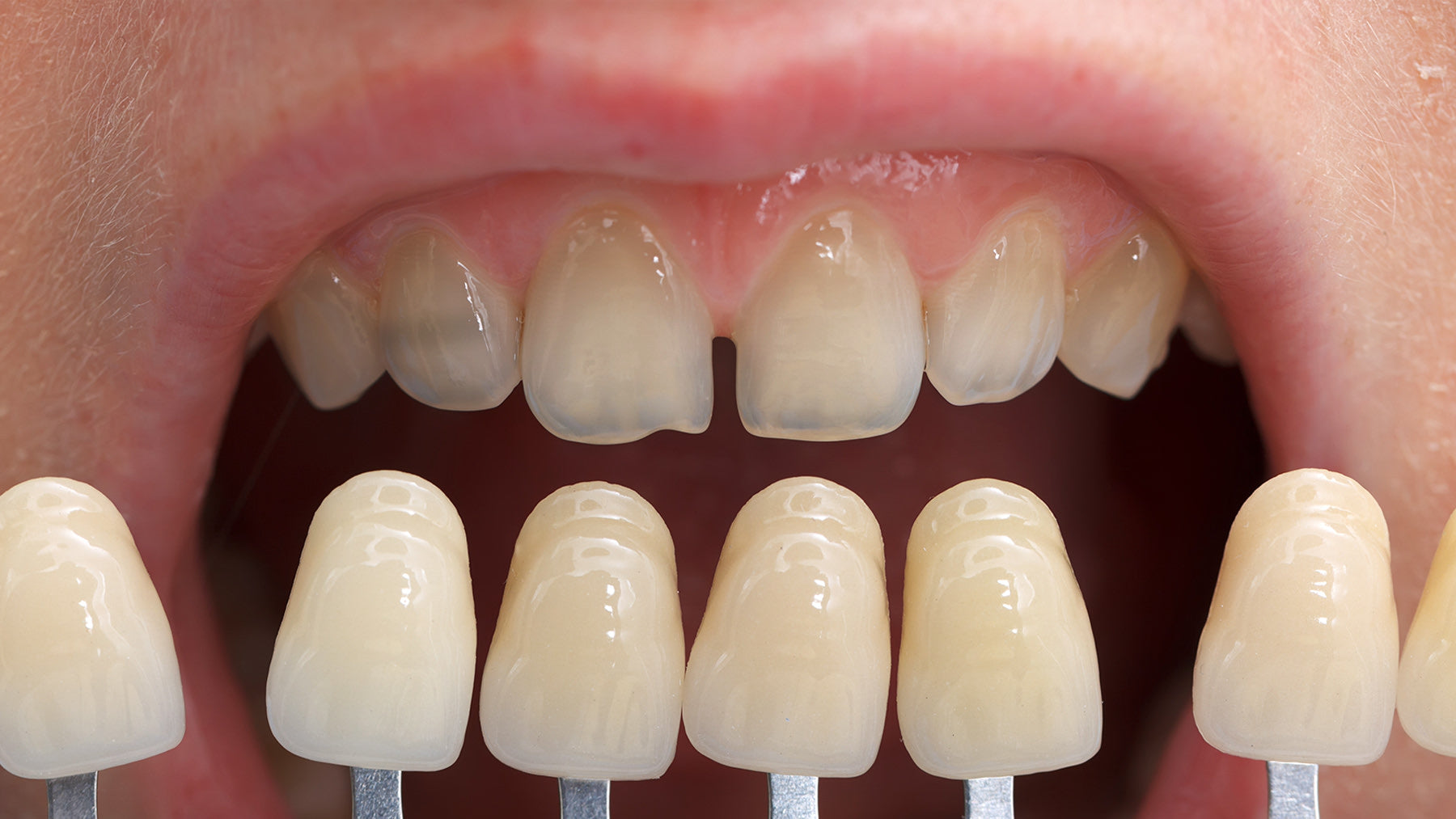 Professional teeth whitening before and after at Fix Studios Cincinnati Mason OH