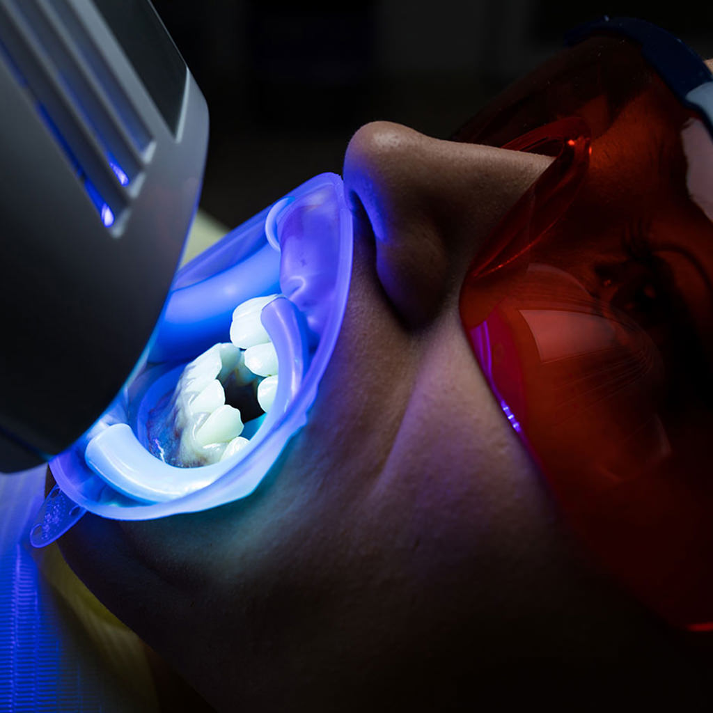 Professional teeth whitening services fix studios cincinnati mason OH