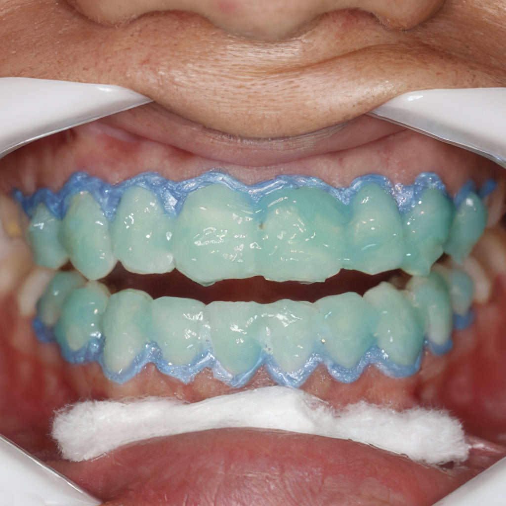 Professional teeth whitening services fix studios cincinnati mason OH
