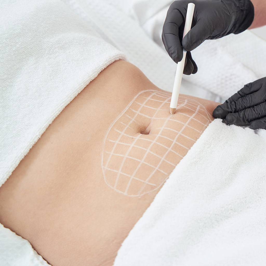 Stretch mark and scar removal treatment fix studios medspa cincinnati mason oh