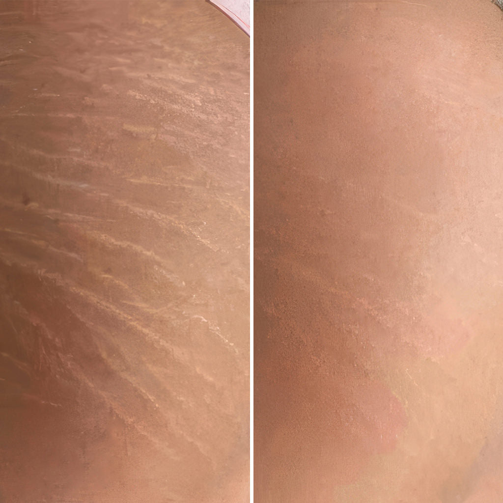 Stretch mark and scar removal treatment before and after fix studios medspa cincinnati mason oh