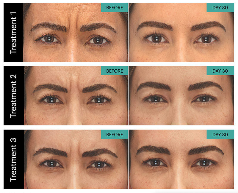 Before and after comparison of Botox facial treatments on a person's face.