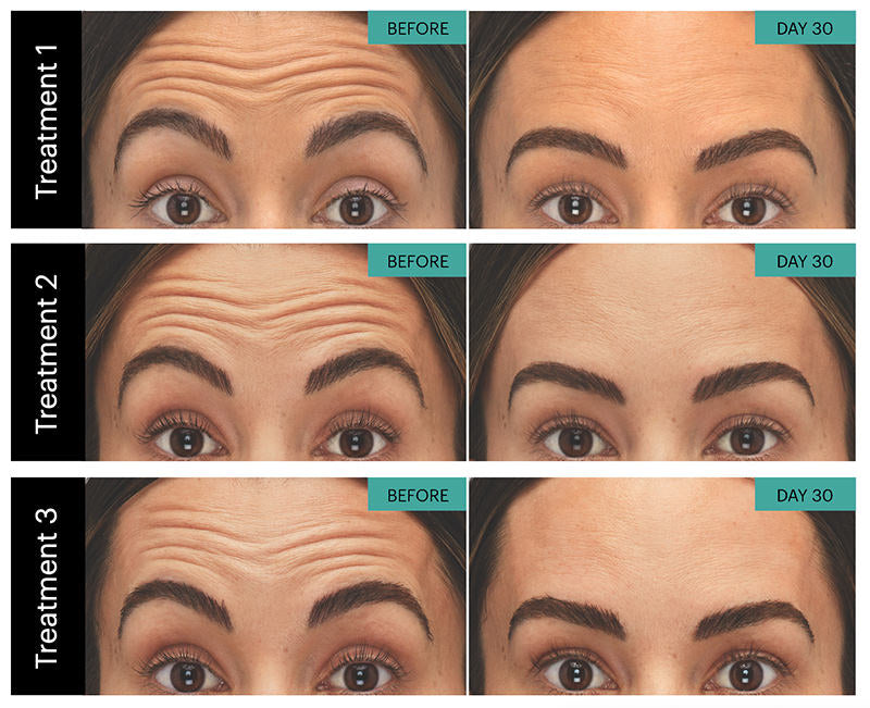 Before and after comparison of Botox facial treatments on a person's face.