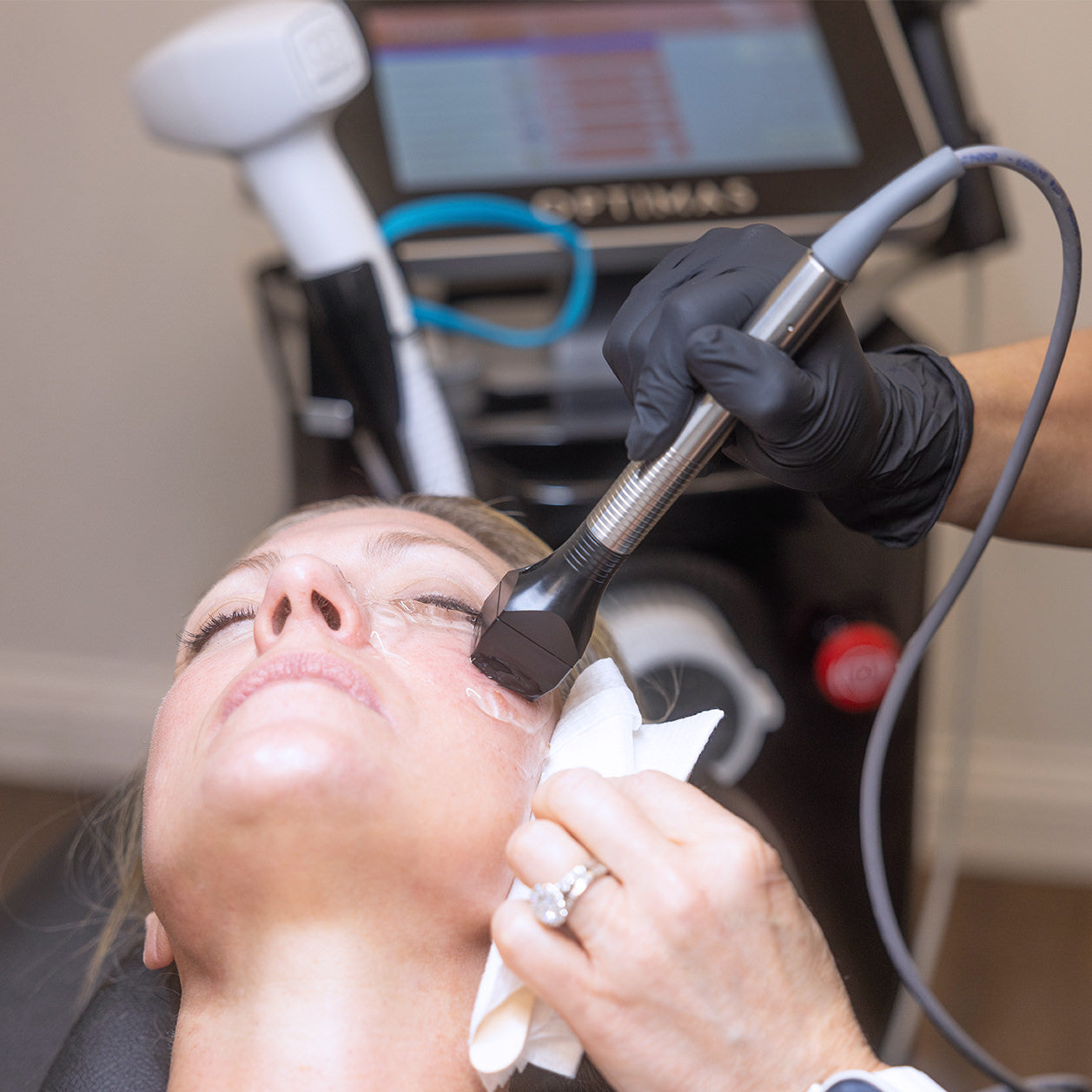 A woman receives a treatment of Forma RF skin tightening Cincinnati Mason OH at Fix Studios