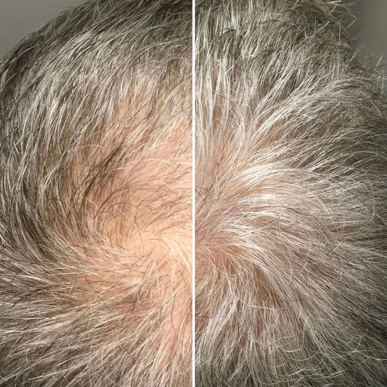 hair restoration treatment results at Fix Studios medspa Cincinnati Mason OH