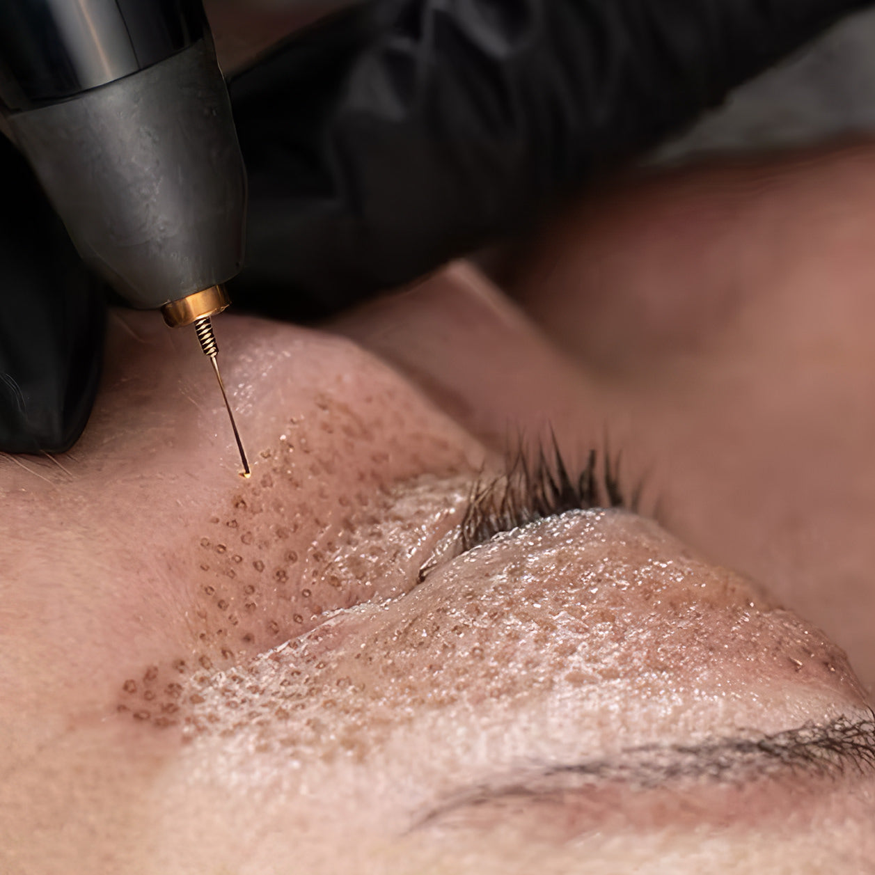 A woman receives a non-surgical eyelid lift with a plasma pen fibroblast treatment at Fix Studios medspa Cincinnati Mason OH