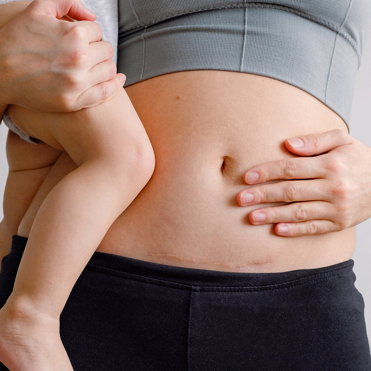 A woman holding a baby with a c section scar being treated at Fix Studios medspa Cincinnati Mason OH