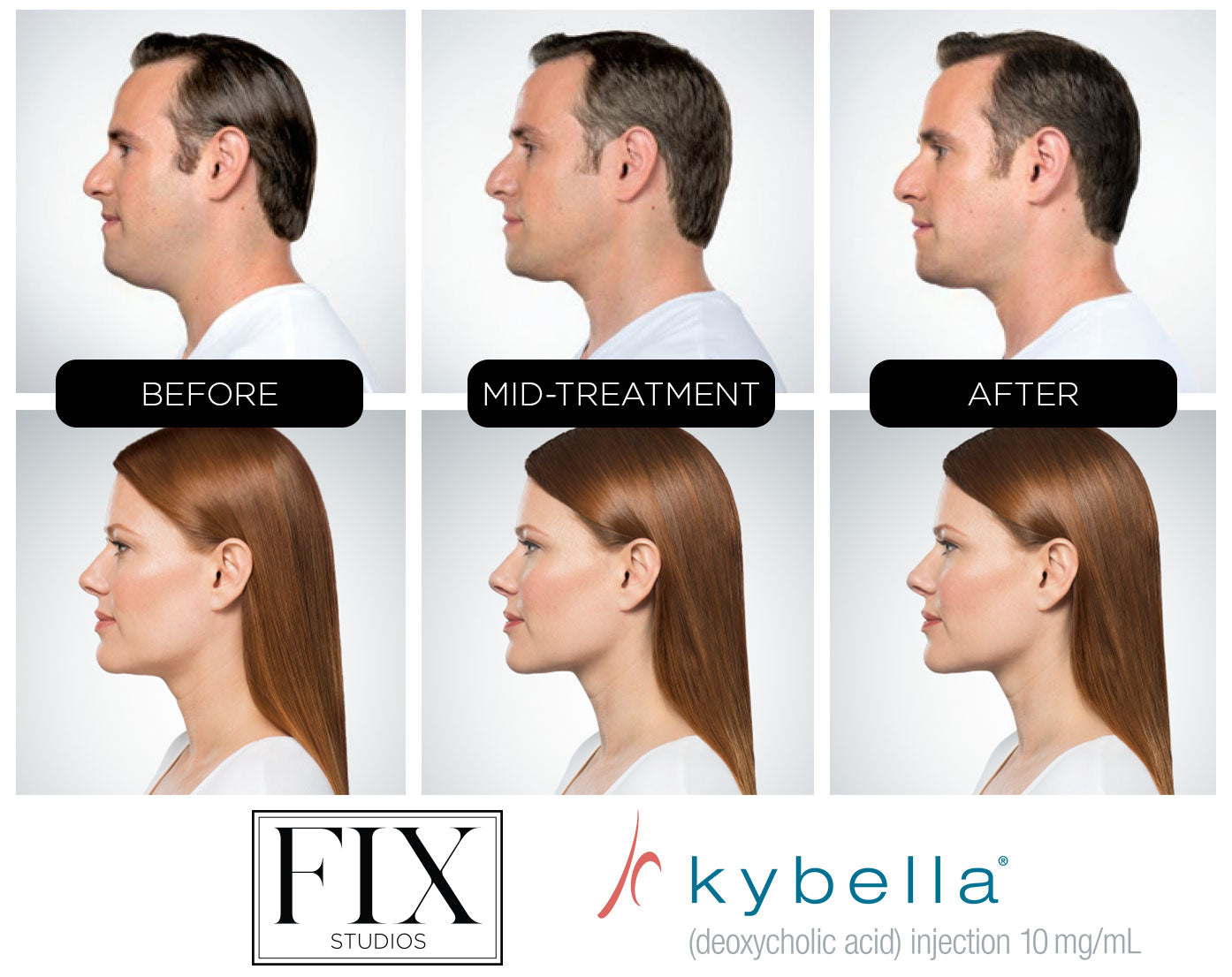 Kybella treatments and services before and after fix studios medspa cincinnati mason OH
