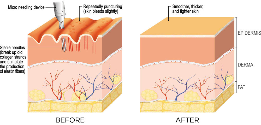 Microneedling anti-aging treatments and services fix studios medspa cincinnati mason OH