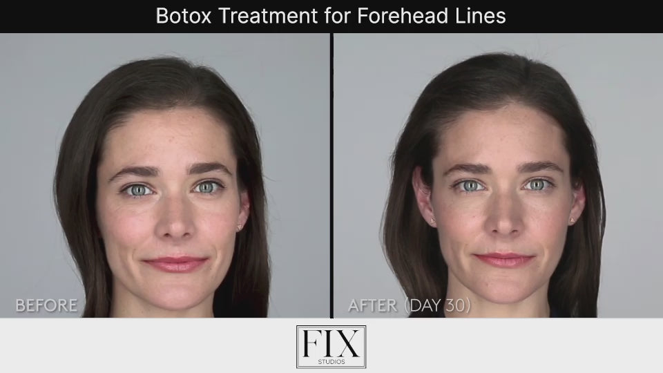 Load video: Before and After Botox Treatment for Forehead Lines Fix Studios Mason Cincinnati OH